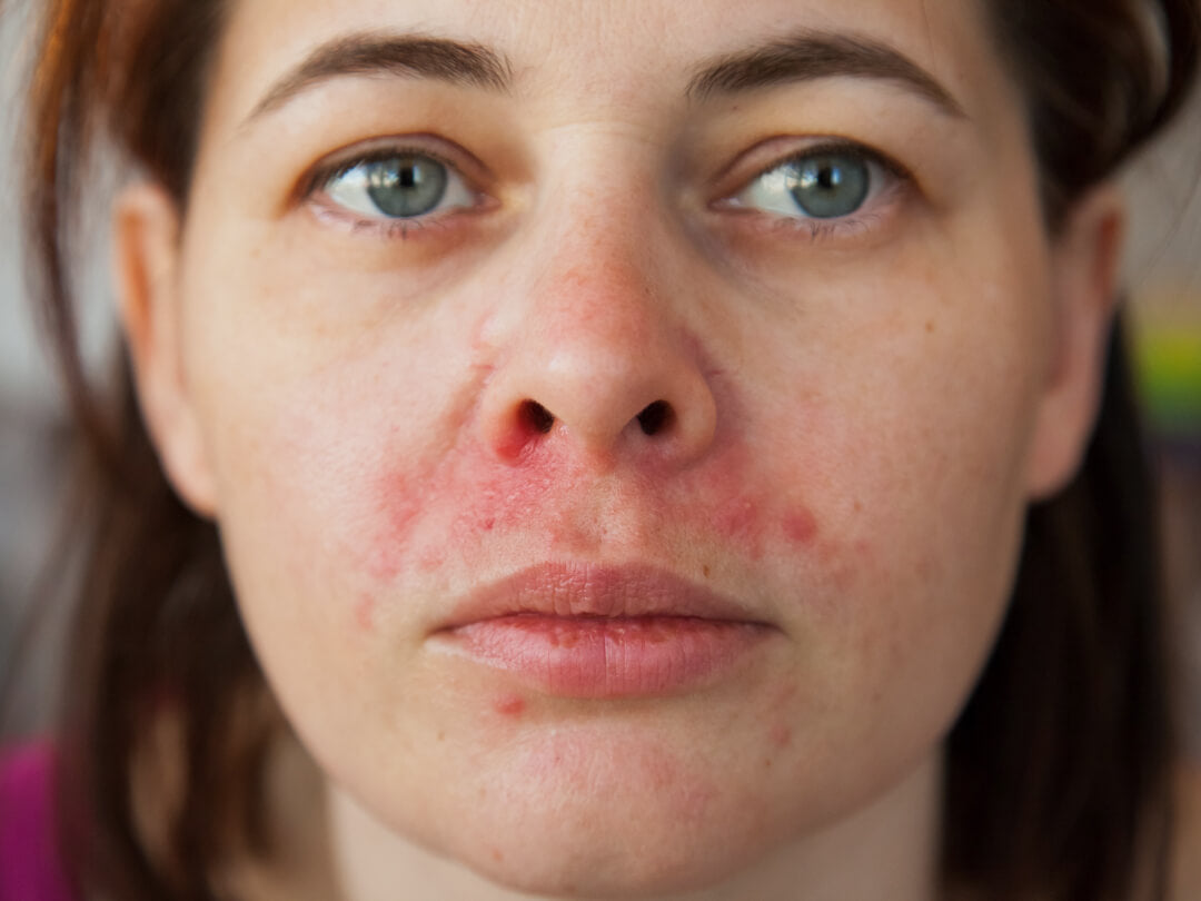 Periorale Dermatitis – Hautproblem rund um den Mund