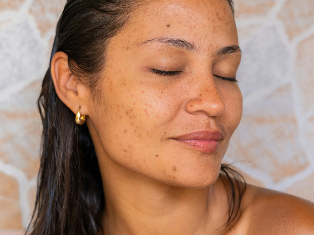 Trockene unreine Haut