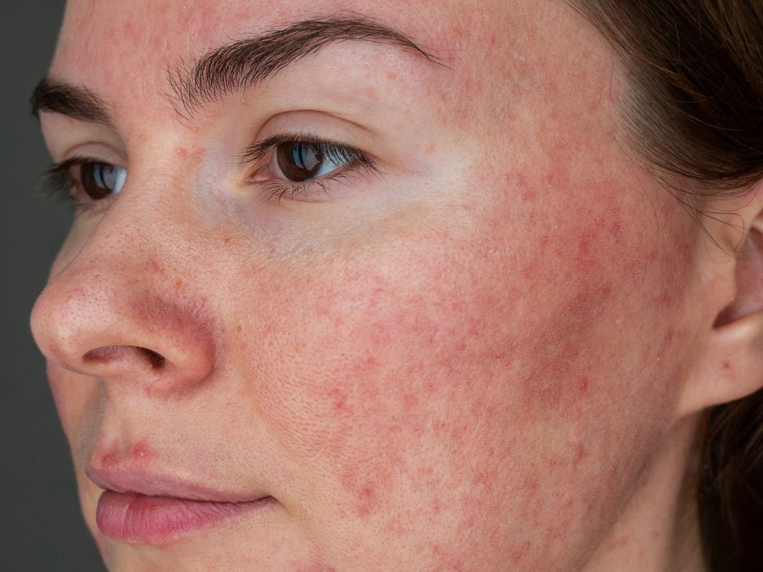 Rosacea – chronisches Hautproblem mit Rötungen und Papeln