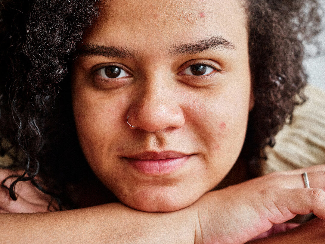 Unreine Haut Ursachen